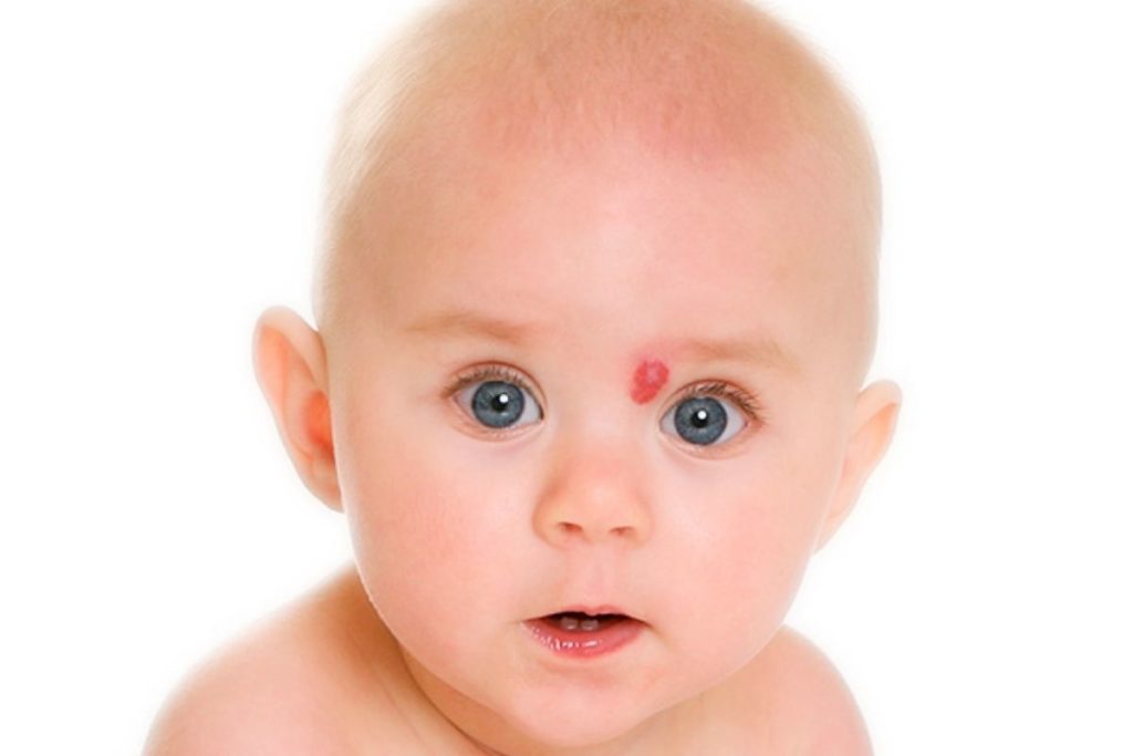 EyeKids | Mancha vermelha na pele: o que é hemangioma capilar ou nevo ...