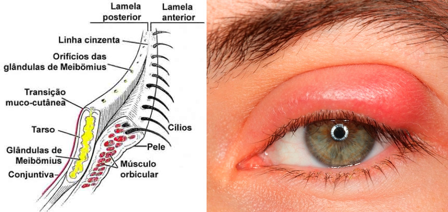 Calázio e hordéolo (terçol) - Distúrbios oftalmológicos - Manuais